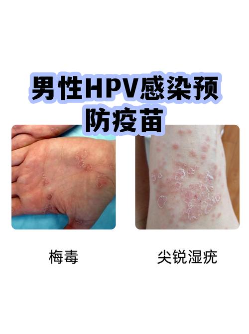 男性HPV疫苗能预防哪些疾病