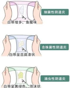 阴道有气排出是正常的吗-两性知识丨两性健康--你想了解的我都知道