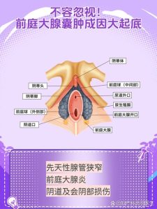 前庭大腺囊肿需要手术吗？看完这篇你就心里有数了-两性知识丨两性健康--你想了解的我都知道
