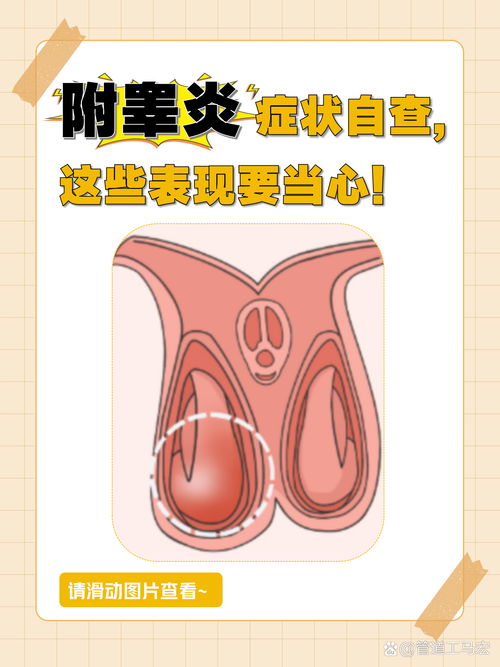 附睾炎有什么症状