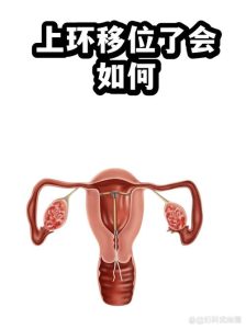 避孕环移位有什么感觉？身体会发出哪些信号？-两性知识丨两性健康--你想了解的我都知道