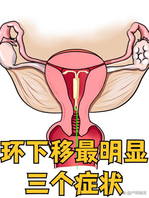 避孕环移位有什么感觉