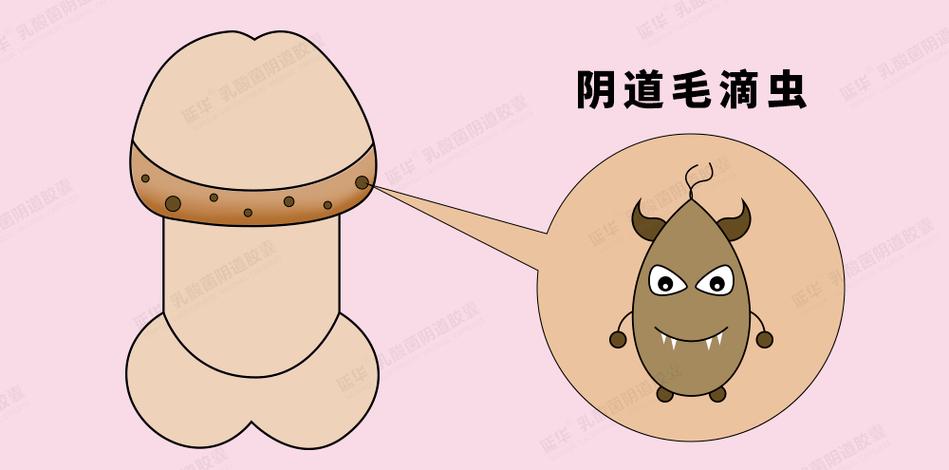 男性感染阴道毛滴虫有症状吗
