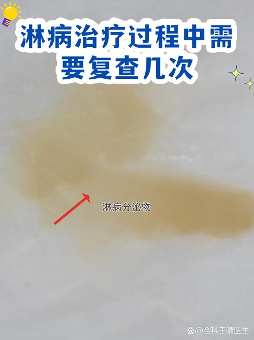淋病治疗后多久复查
