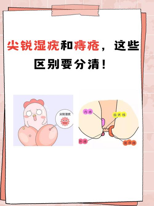尖锐湿疣和痔疮怎么区分