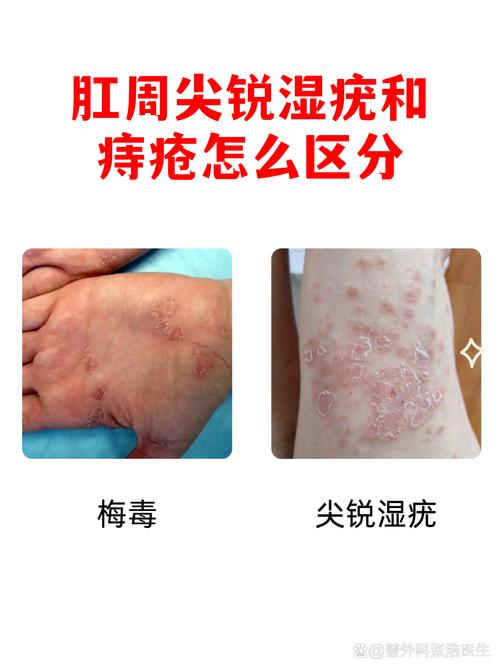 尖锐湿疣和痔疮怎么区分