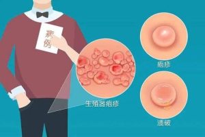 生殖器疱疹发作前,身体会提前发出哪些信号?-两性知识丨两性健康--你想了解的我都知道