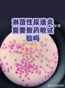 生殖道感染到底要不要做药敏试验?看完这篇心里有数-两性知识丨两性健康--你想了解的我都知道
