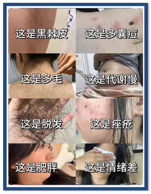 多囊和多毛症怎么区分