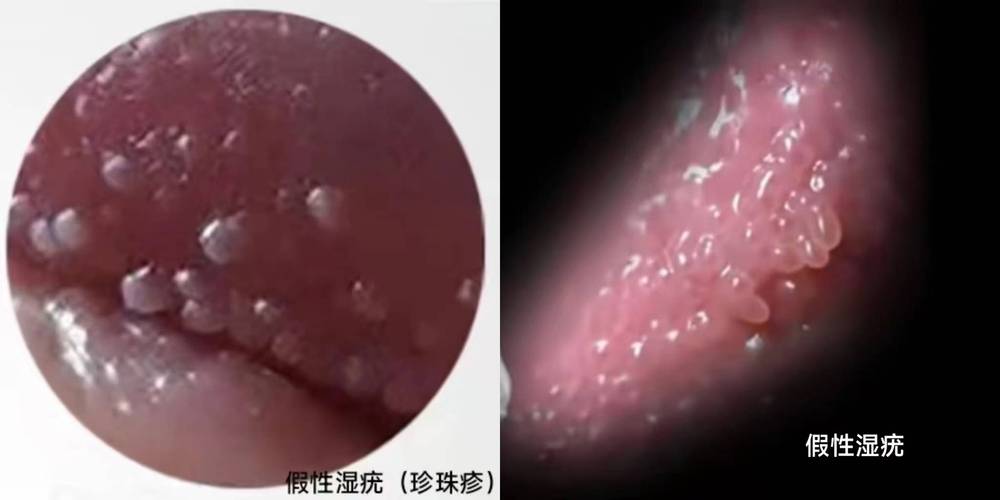 外阴长小疙瘩是正常的吗