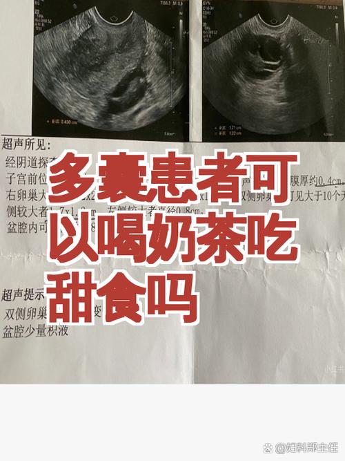 多囊患者能喝奶茶吗