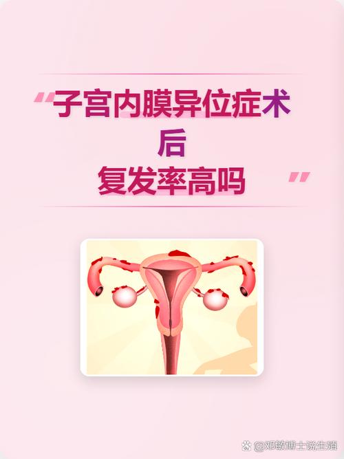 内异症患者产后会复发吗