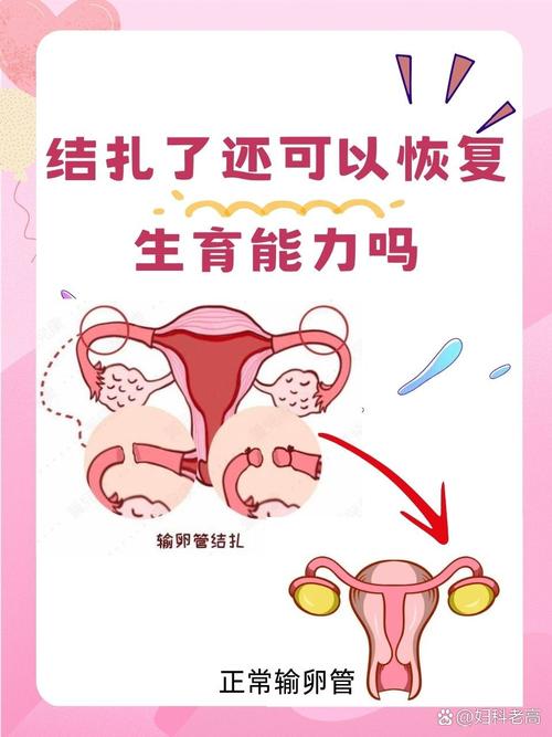 结扎后还能恢复生育吗