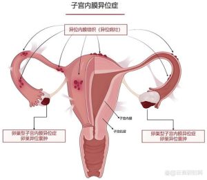 子宫内膜异位症能怀孕吗-两性知识丨两性健康--你想了解的我都知道