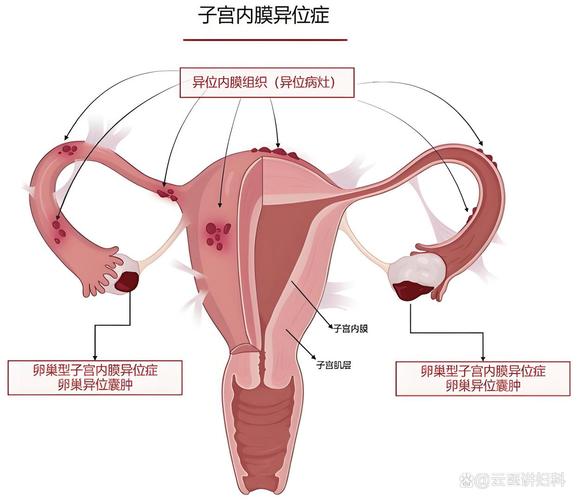 子宫内膜异位症能怀孕吗