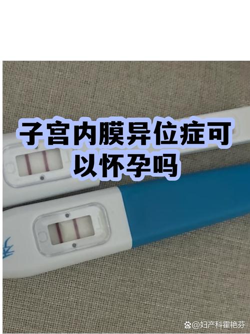 子宫内膜异位症能怀孕吗