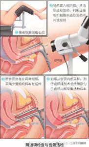 阴道镜活检能查出癌吗-两性知识丨两性健康--你想了解的我都知道