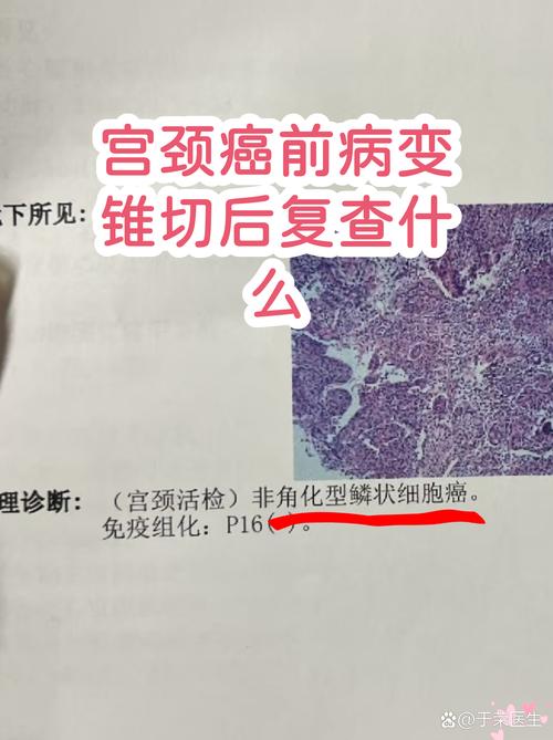 宫颈病变治疗前要评估什么
