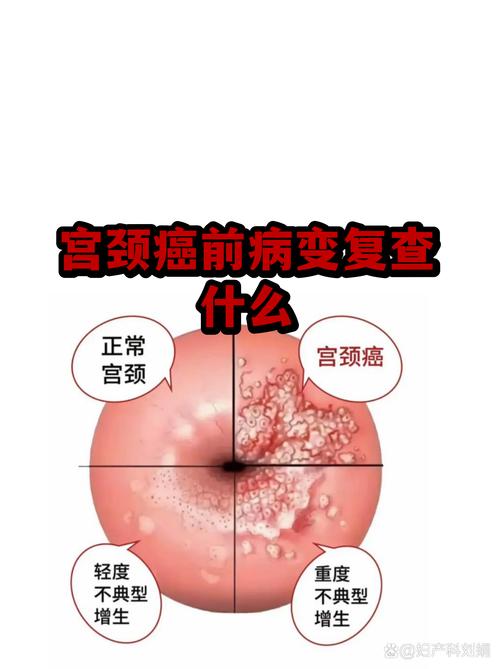 宫颈病变治疗后备孕前要检查吗