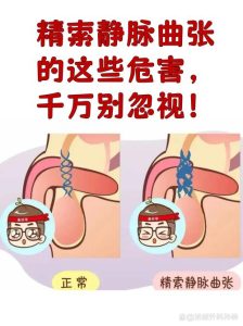 精子碎片率高,跟精索静脉曲张到底有没有关系?-两性知识丨两性健康--你想了解的我都知道