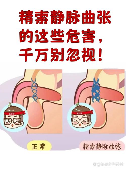 精子碎片率高和精索静脉曲张有关吗