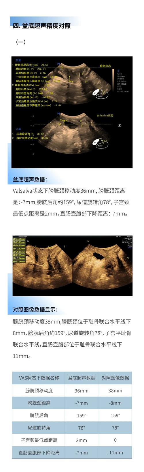 盆底超声能查出什么