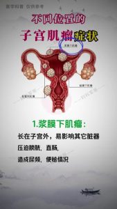 子宫肉瘤早期有哪些表现?这5个信号千万别当成小毛病忽略掉-两性知识丨两性健康--你想了解的我都知道