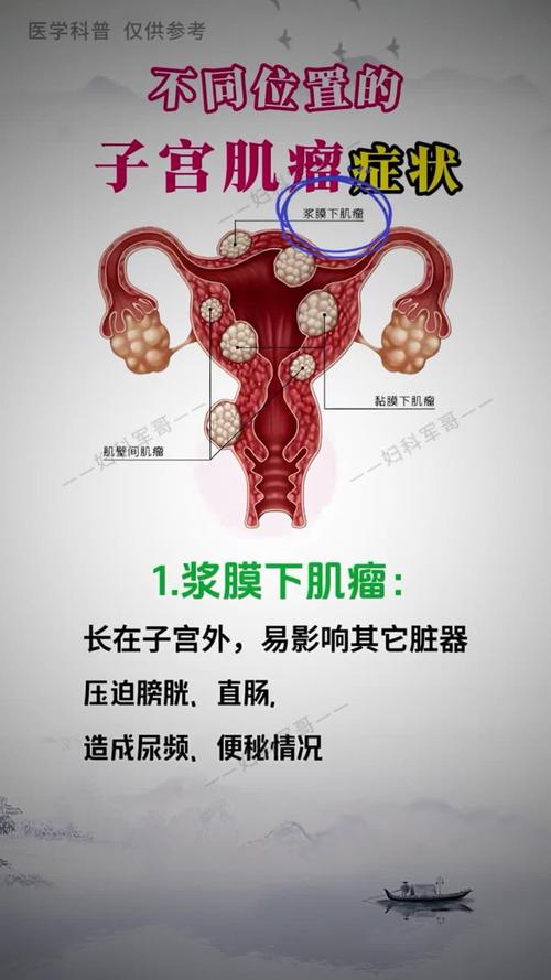 子宫肉瘤早期有哪些表现