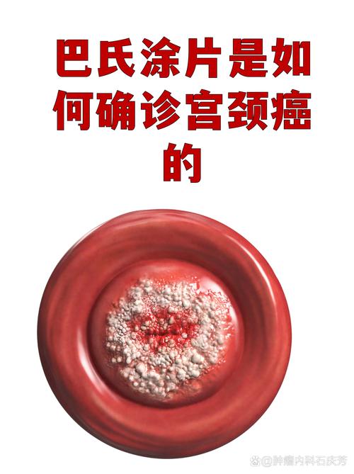 巴氏涂片能查出哪些癌症
