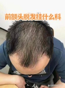 脱发到底该挂皮肤科还是男科?一文帮你搞清楚!😵-两性知识丨两性健康--你想了解的我都知道