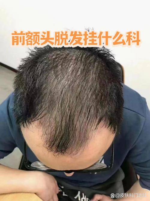 脱发该挂皮肤科还是男科