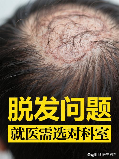 脱发该挂皮肤科还是男科