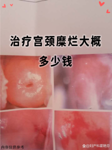 宫颈病变无创治疗靠谱吗-两性知识丨两性健康--你想了解的我都知道