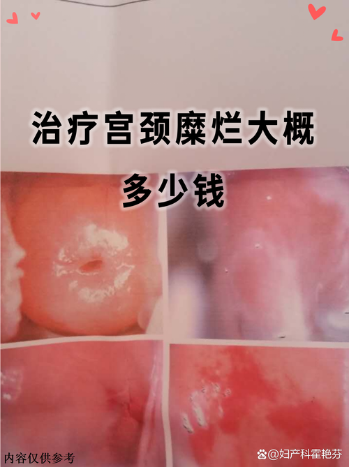 宫颈病变无创治疗靠谱吗