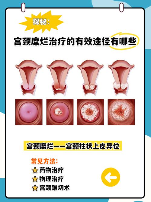 宫颈病变无创治疗靠谱吗