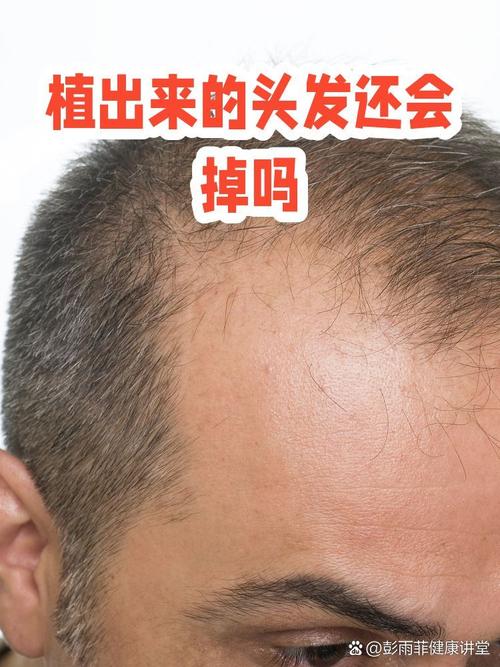 植发后原来的头发还会掉吗