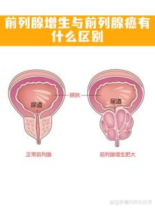 前列腺癌和前列腺增生怎么区分-两性知识丨两性健康--你想了解的我都知道