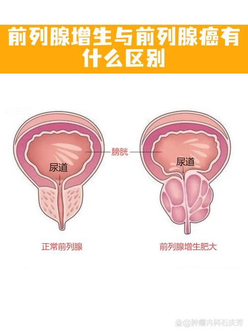 前列腺癌和前列腺增生怎么区分