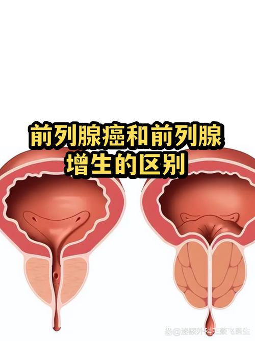 前列腺癌和前列腺增生怎么区分