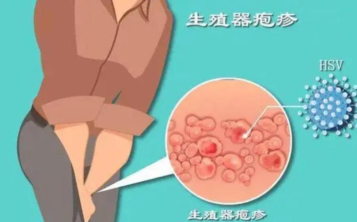 生殖器疱疹能根治吗