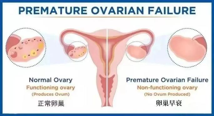 卵巢早衰能用干细胞治疗吗
