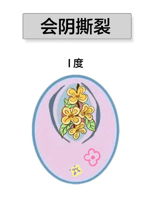 顺产撕裂会影响性欲吗