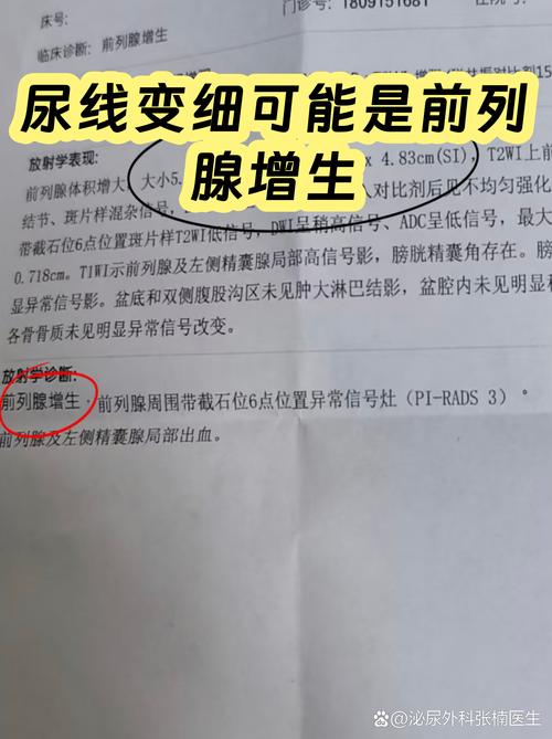 尿线变细或尿等待,是增生信号吗