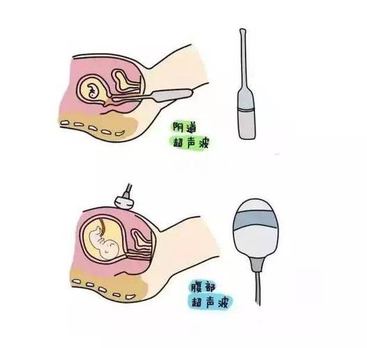阴道B超和腹部B超怎么选