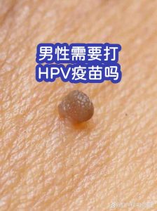 男生需要打HPV疫苗吗-两性知识丨两性健康--你想了解的我都知道