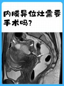 内异症要做核磁共振吗-两性知识丨两性健康--你想了解的我都知道