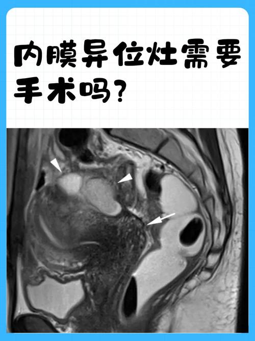 内异症要做核磁共振吗