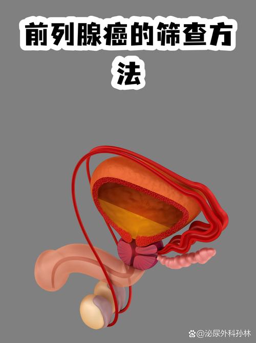 前列腺癌怎么筛查,医生给你讲清楚