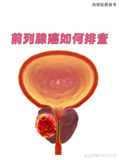 前列腺癌怎么筛查,医生给你讲清楚