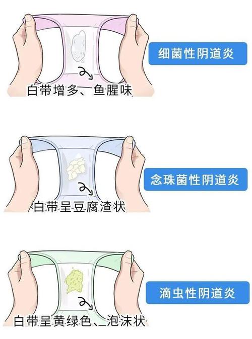 阴道炎反复和伴侣有关吗